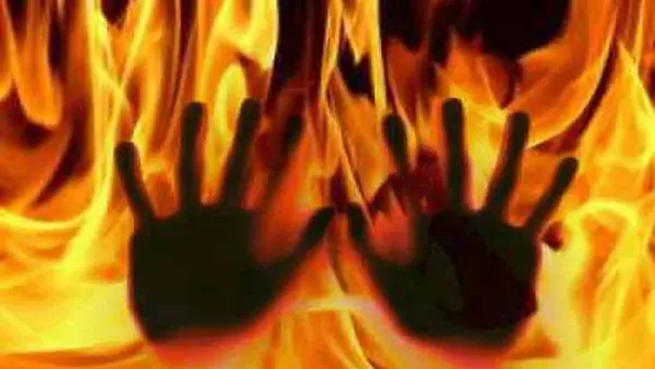 Ganjam: Woman Burned by In-Laws Over Dowry Demand; Suffers Severe Injuries