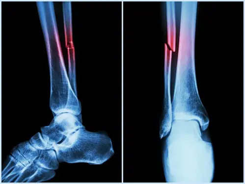 NIT Rourkela study to boost bone regeneration technology