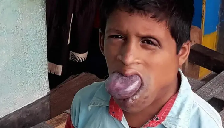 Ganjam Admin Shows Humane Face, Lends Hand to Boy Suffering from Hemangioma
