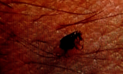 Odisha Govt Asks Dist Health Authorities to Increase Surveillance on Scrub Typhus